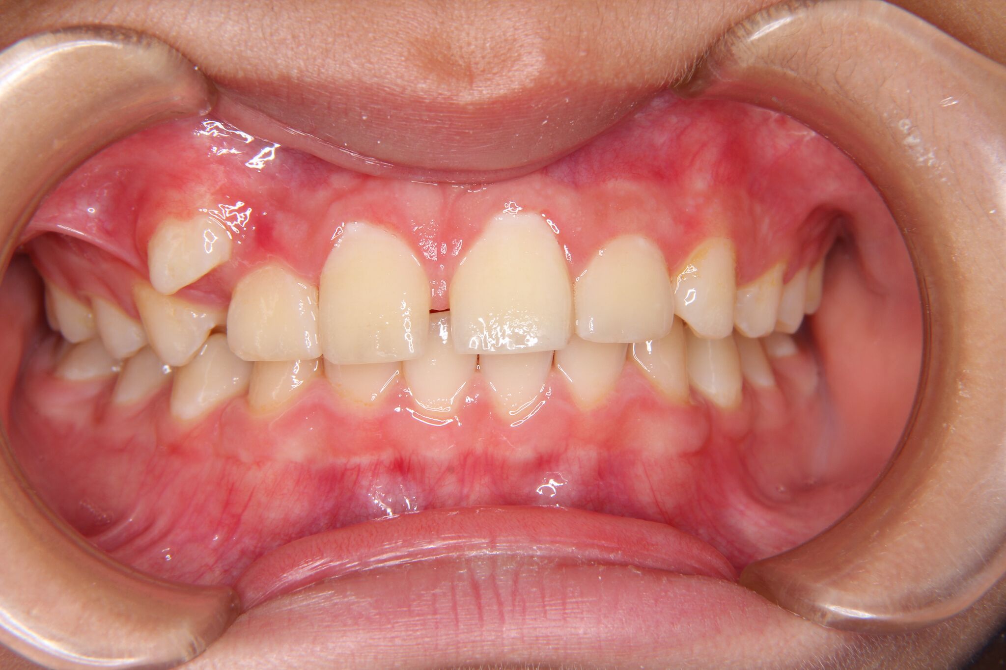 【小学生男子】深い噛み合わせ・上顎の犬歯スペース不足の矯正歯科治療