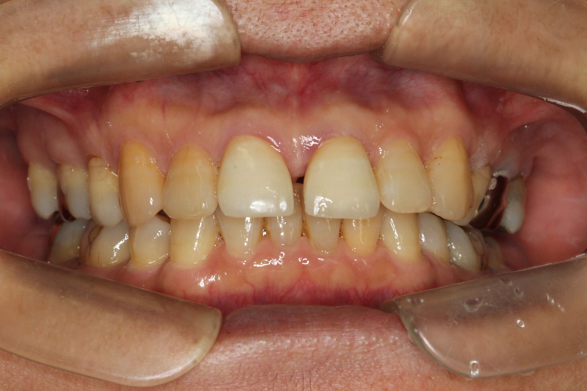 【70代　女性】前歯のすきっぱの矯正歯科治療