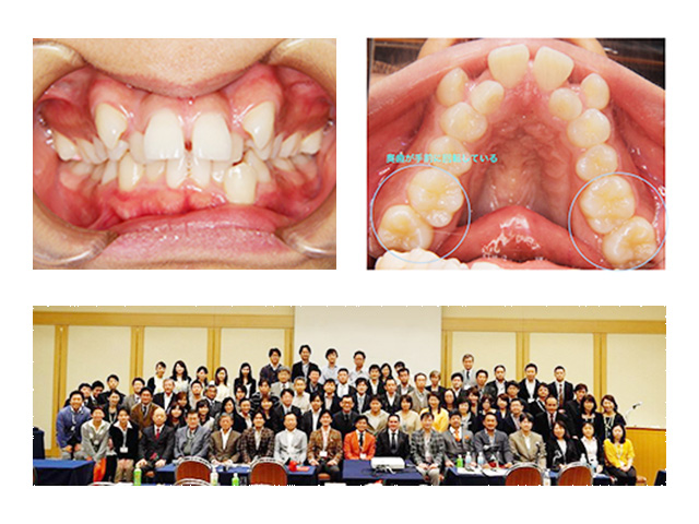 非抜歯治療の考え方（２）〜不正咬合と奥歯について〜　画像