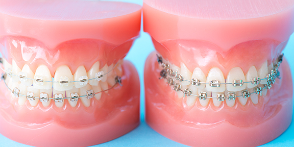 歯列矯正の症例紹介
