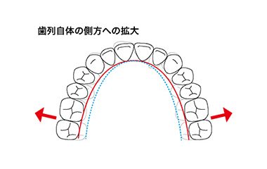 歯列を広げます