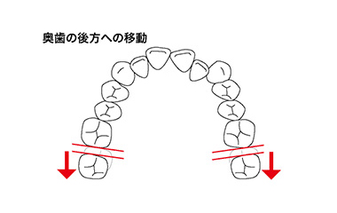 歯列を奥に動かします