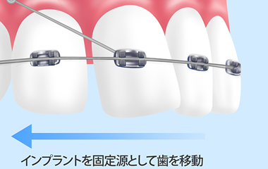 抜歯を避けるためのもうひとつの治療法「矯正用のインプラント」