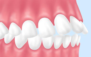 出っ歯の矯正 練馬区大泉学園の歯医者 よしかわ矯正歯科