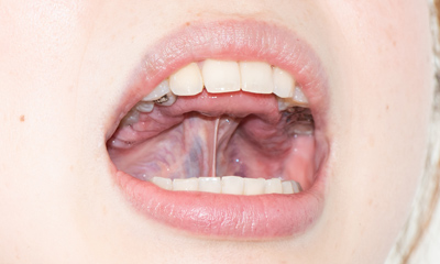 MFT（口腔筋機能療法）とは｜大泉学園の矯正歯科|練馬区大泉学園駅から1分「よしかわ矯正歯科」
