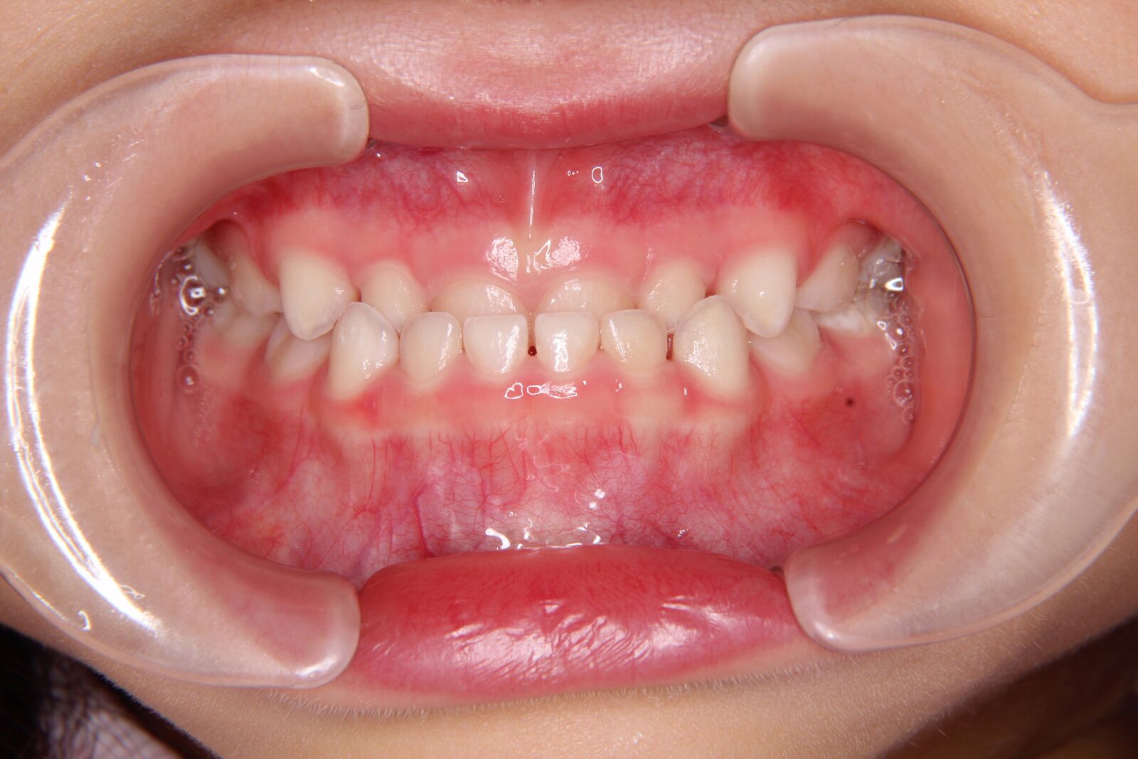 受け口の治療法（乳歯列期）｜よしかわ矯正歯科 症例