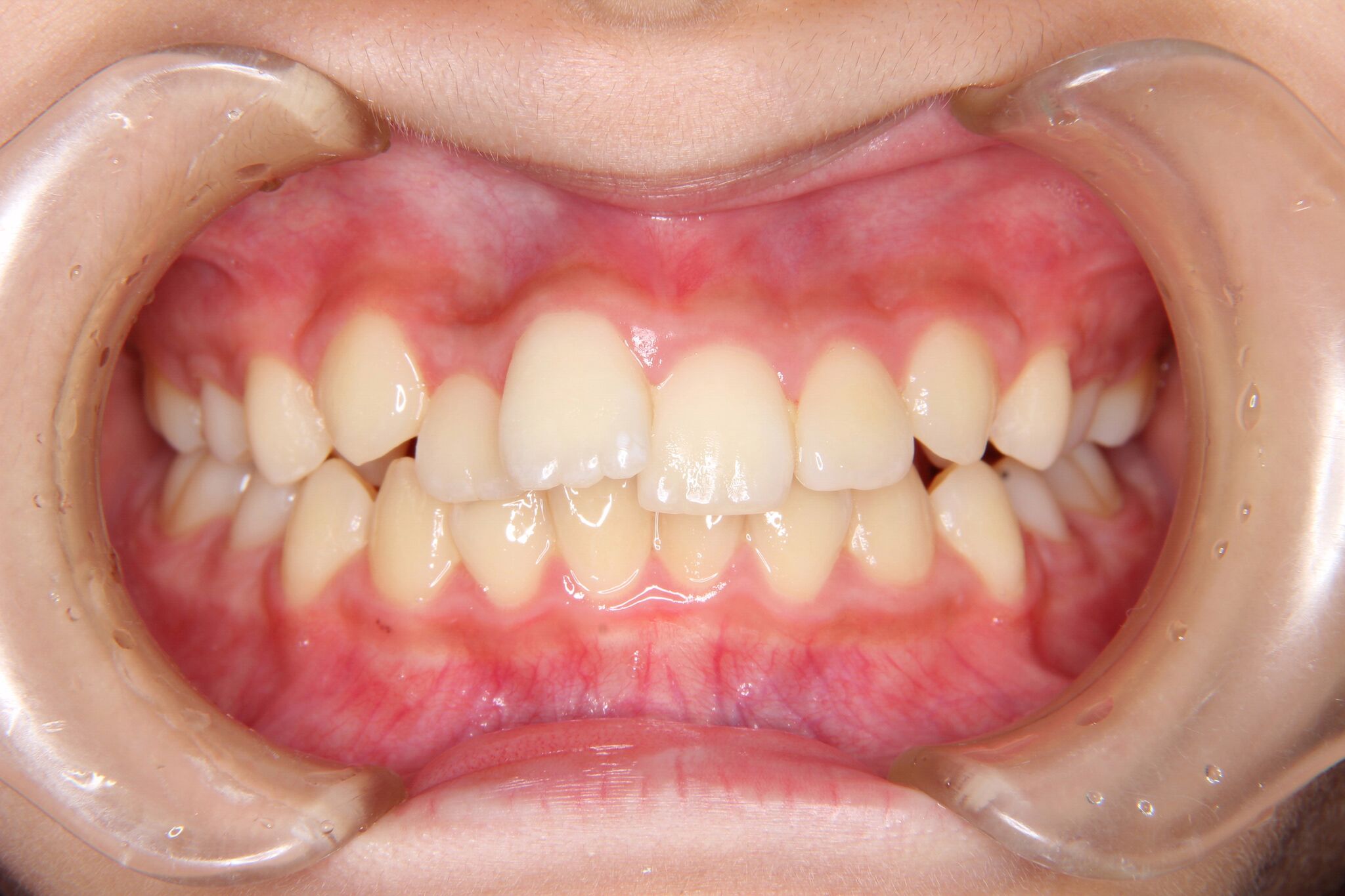 【中学生女子】上顎前歯部がたがた歯の矯正歯科治療