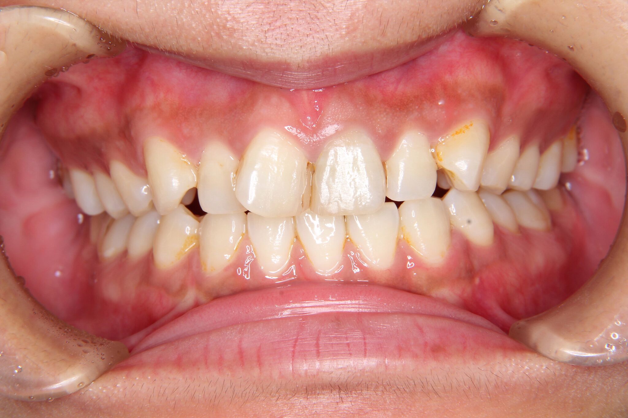 【30代　女性】上顎前歯のがたがた歯・下顎前歯一本欠損（先天欠如）の矯正歯科治療