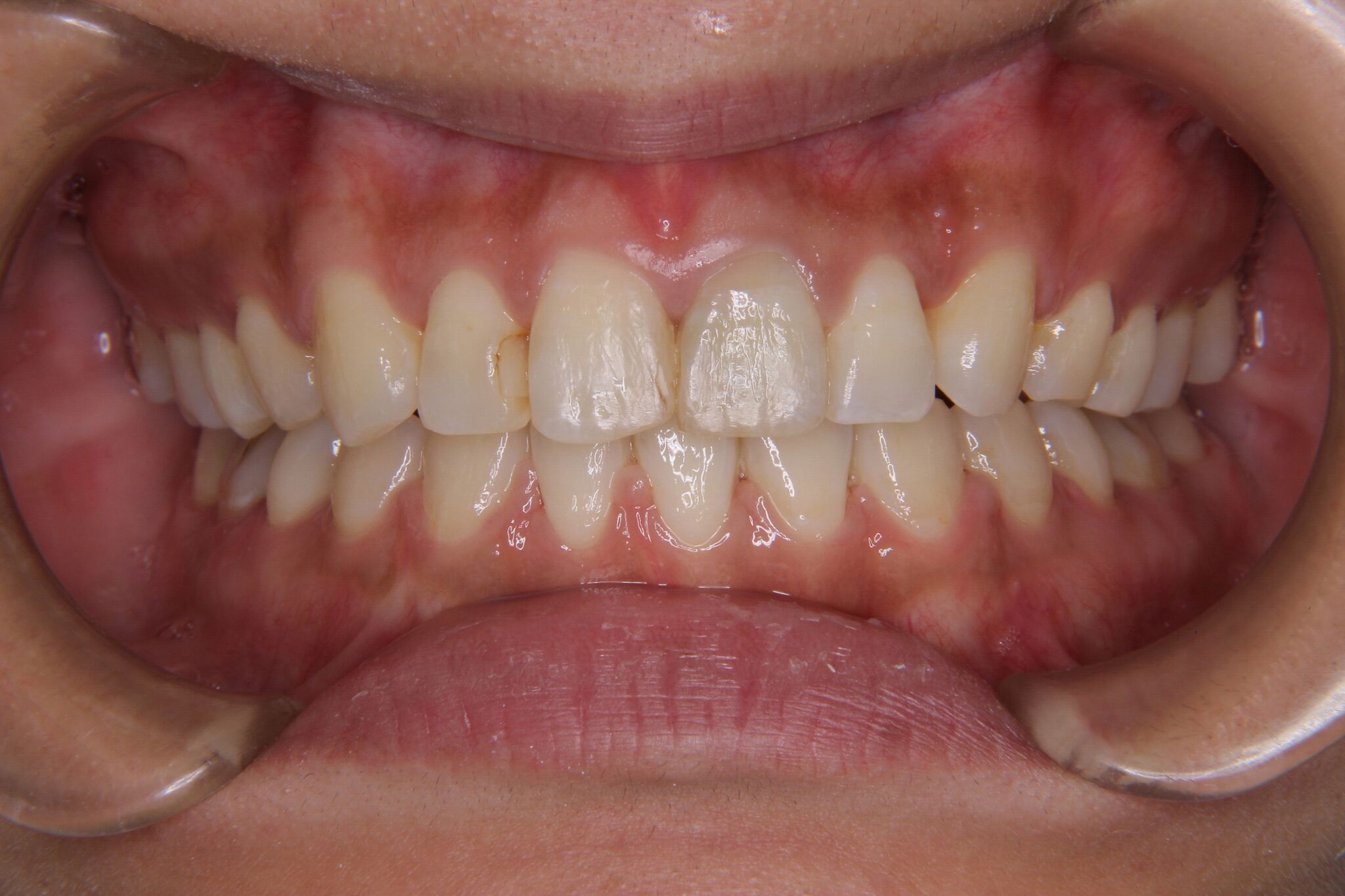 【30代　女性】上顎前歯のがたがた歯・下顎前歯一本欠損（先天欠如）の矯正歯科治療