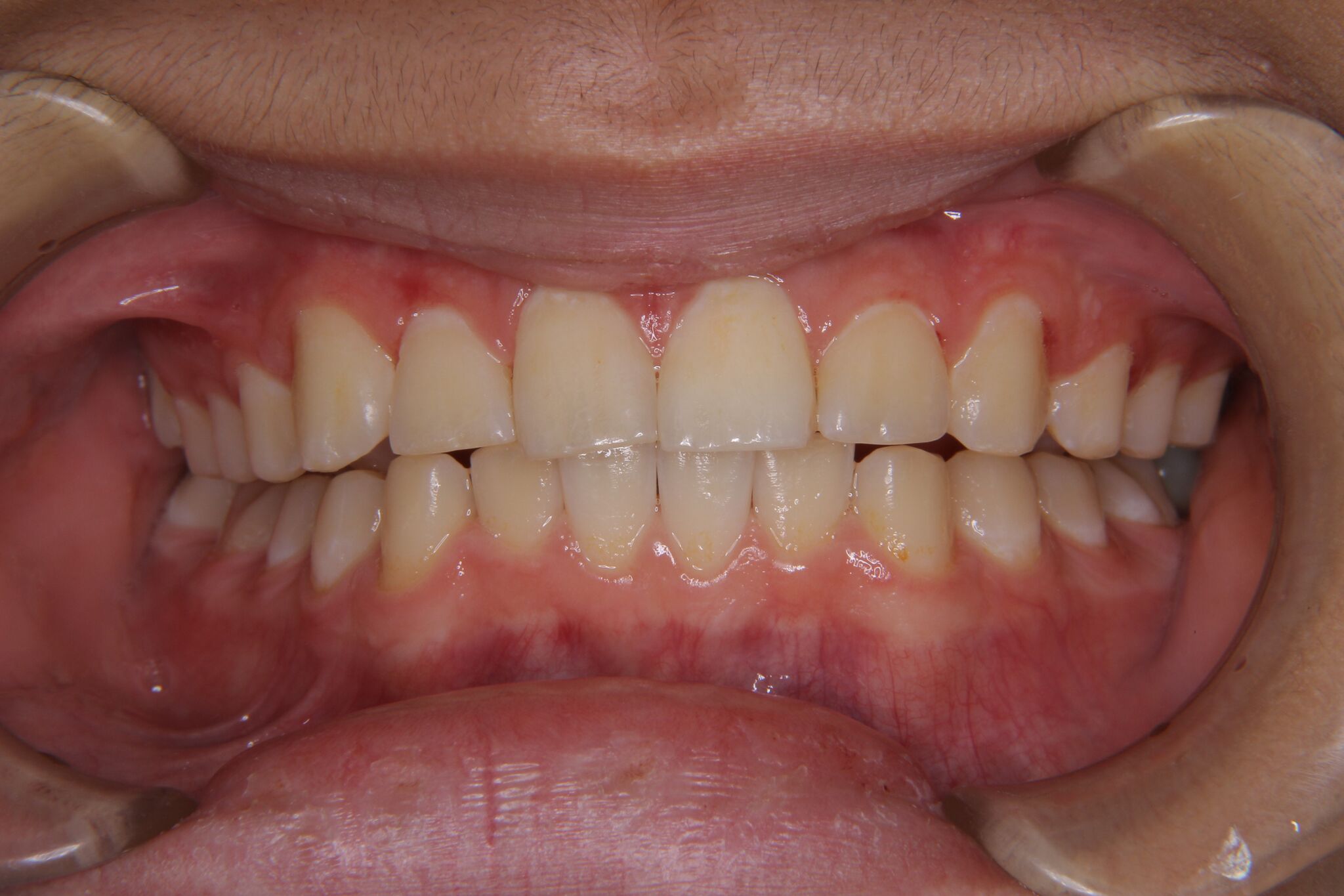 【小学生男子】深い噛み合わせ・上顎の犬歯スペース不足の矯正歯科治療