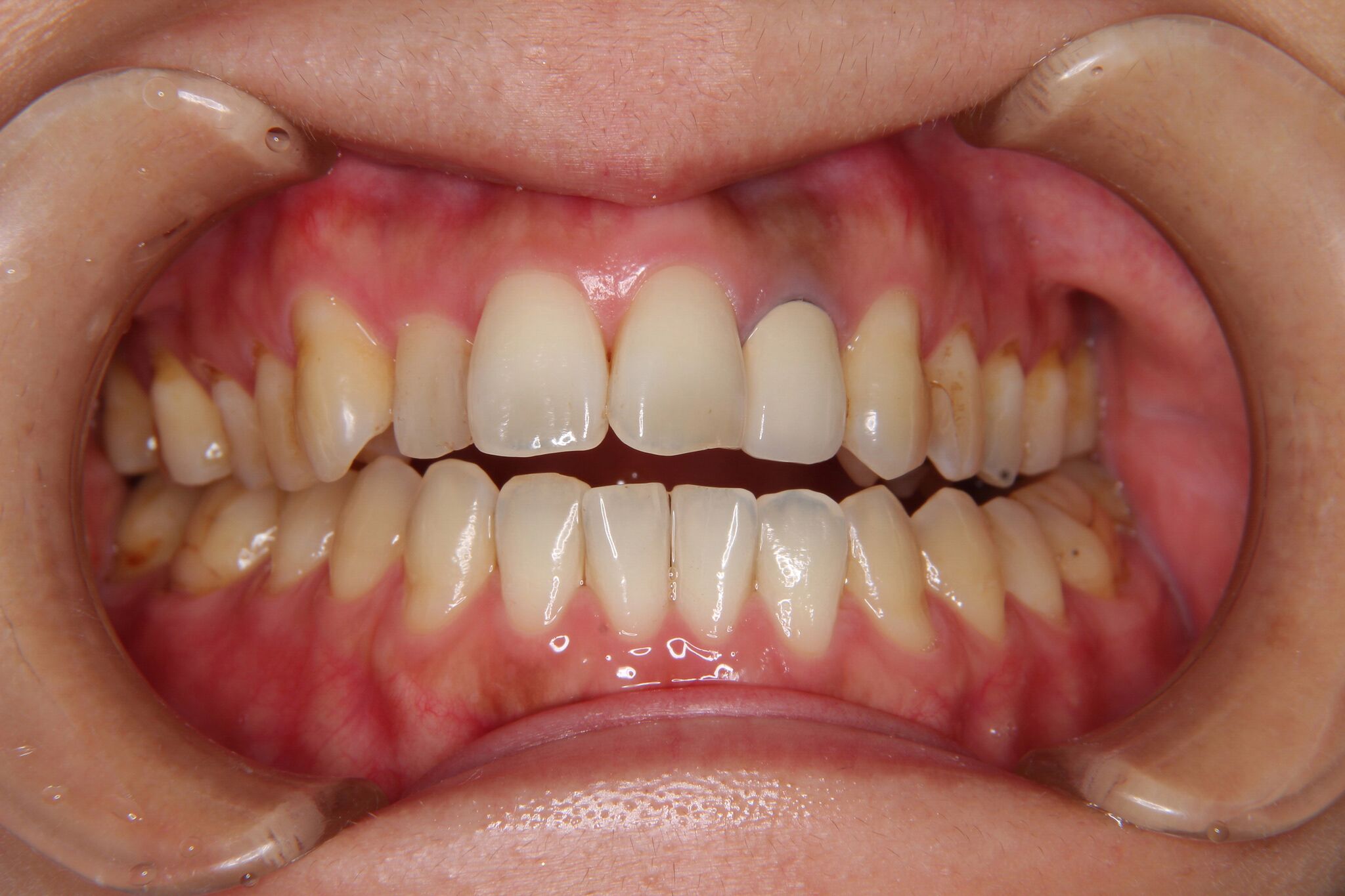 【30代女性】開口・下顎のずれ・がたがた歯の矯正歯科治療