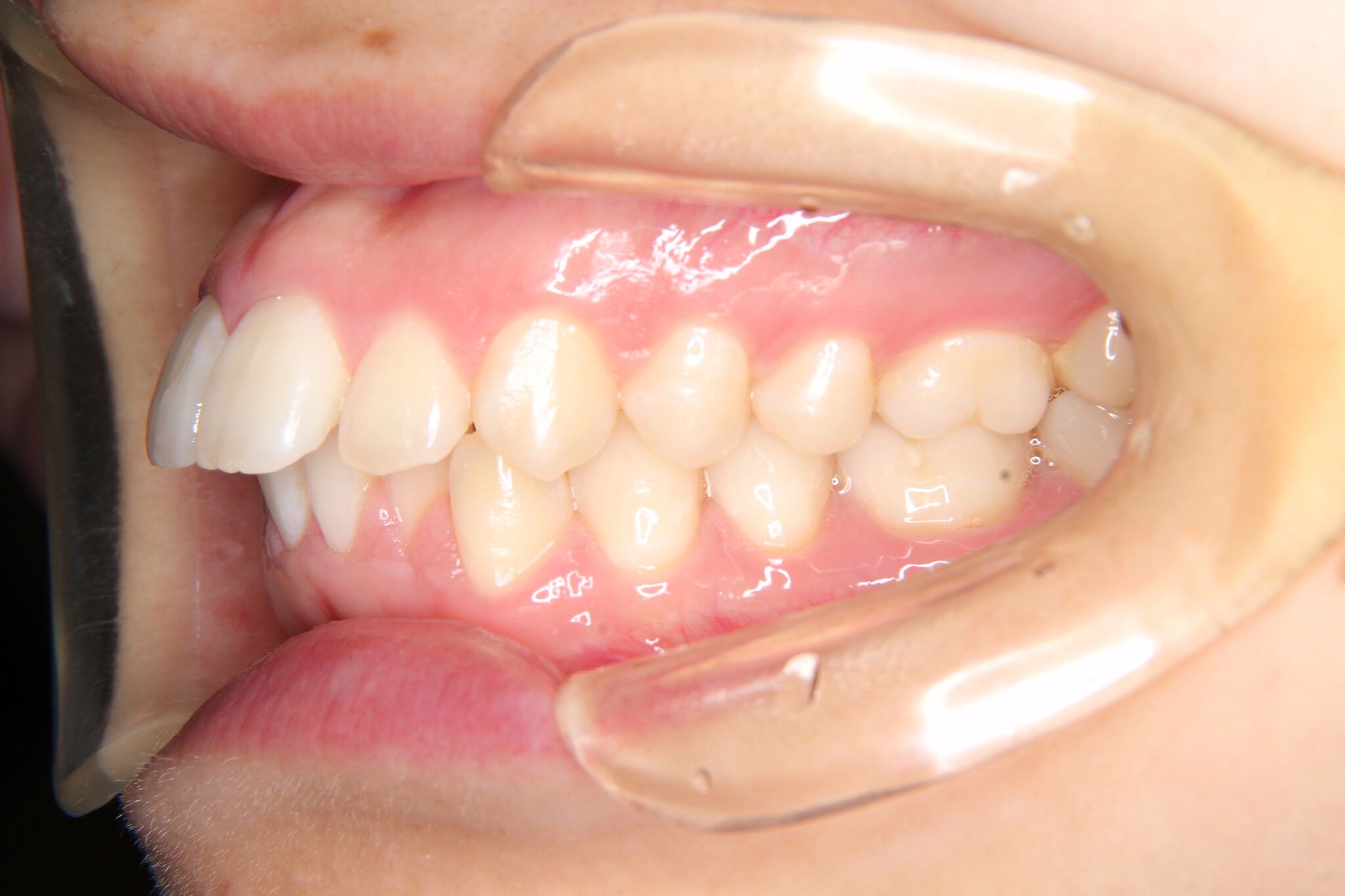 歯 の 矯正 出っ歯