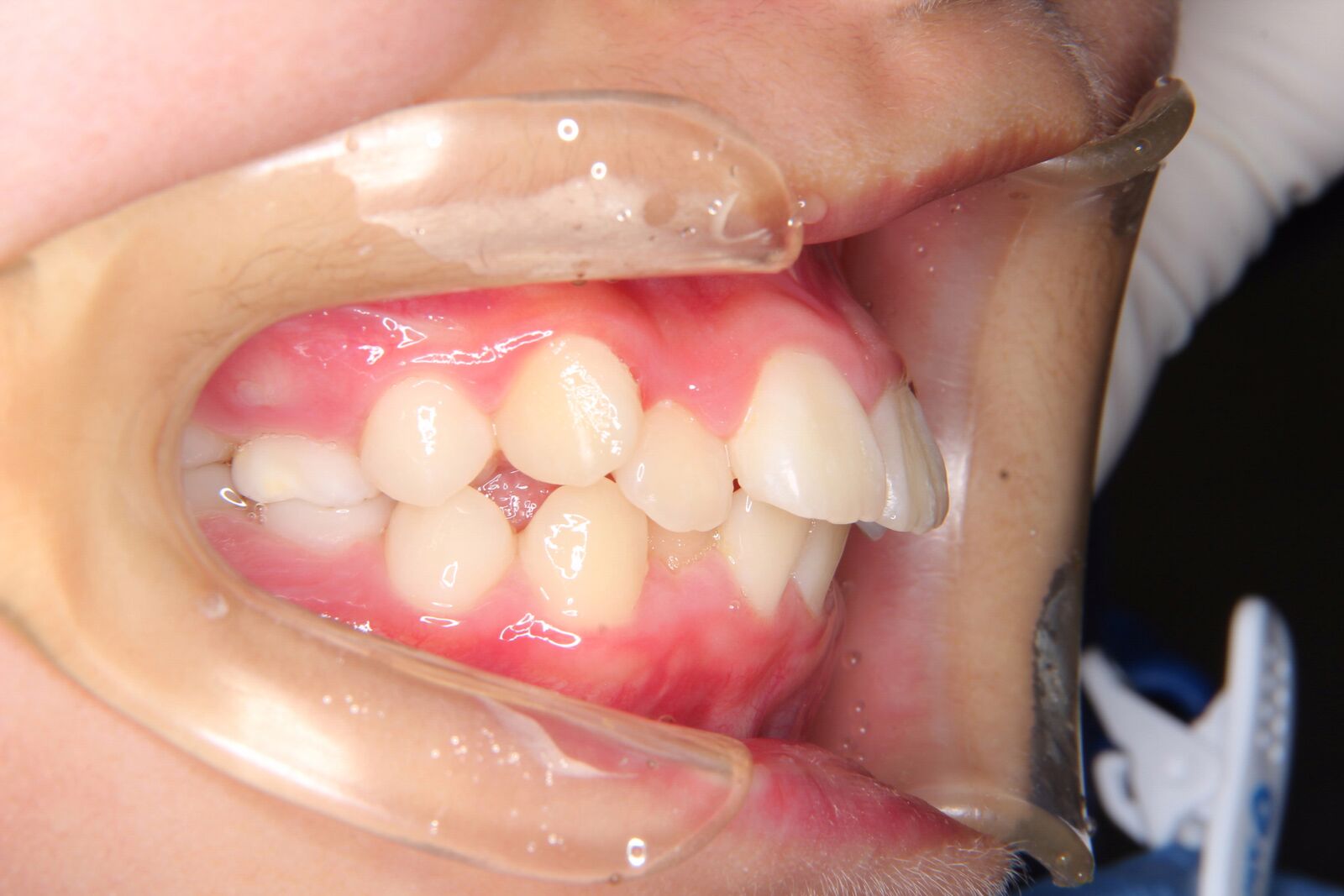 【中学生　女子】上下顎前歯がたがた歯の矯正歯科治療