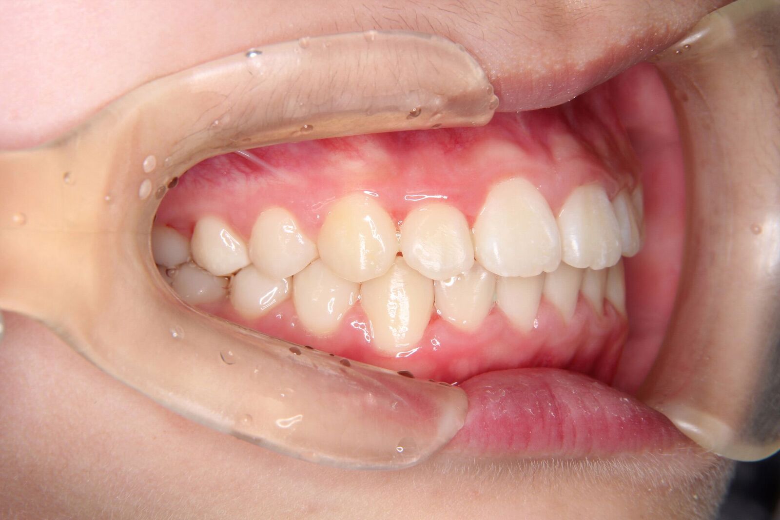 【中学生　女子】上下顎前歯がたがた歯の矯正歯科治療