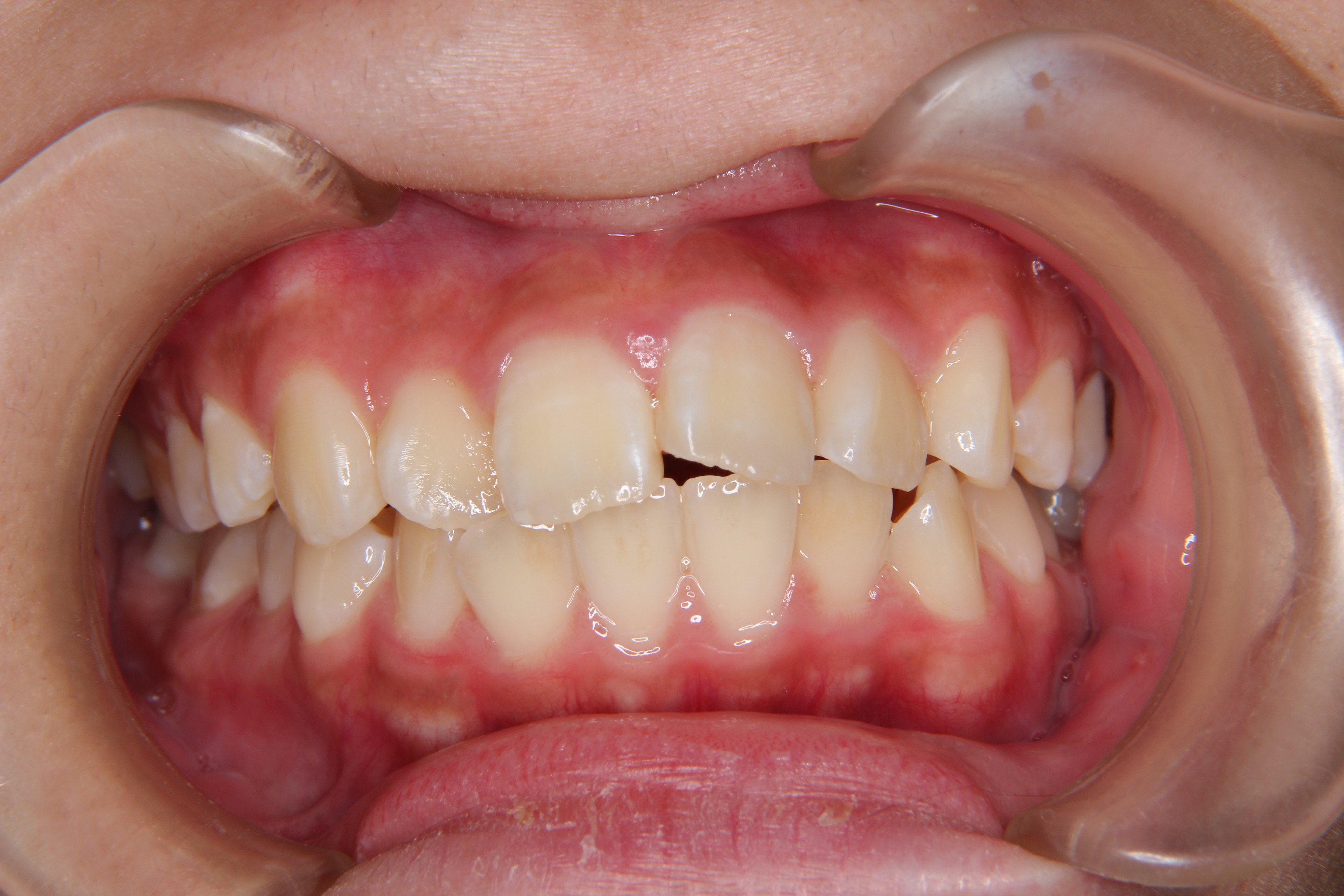 【高校生女子】上顎前歯のガタガタ歯の矯正歯科治療