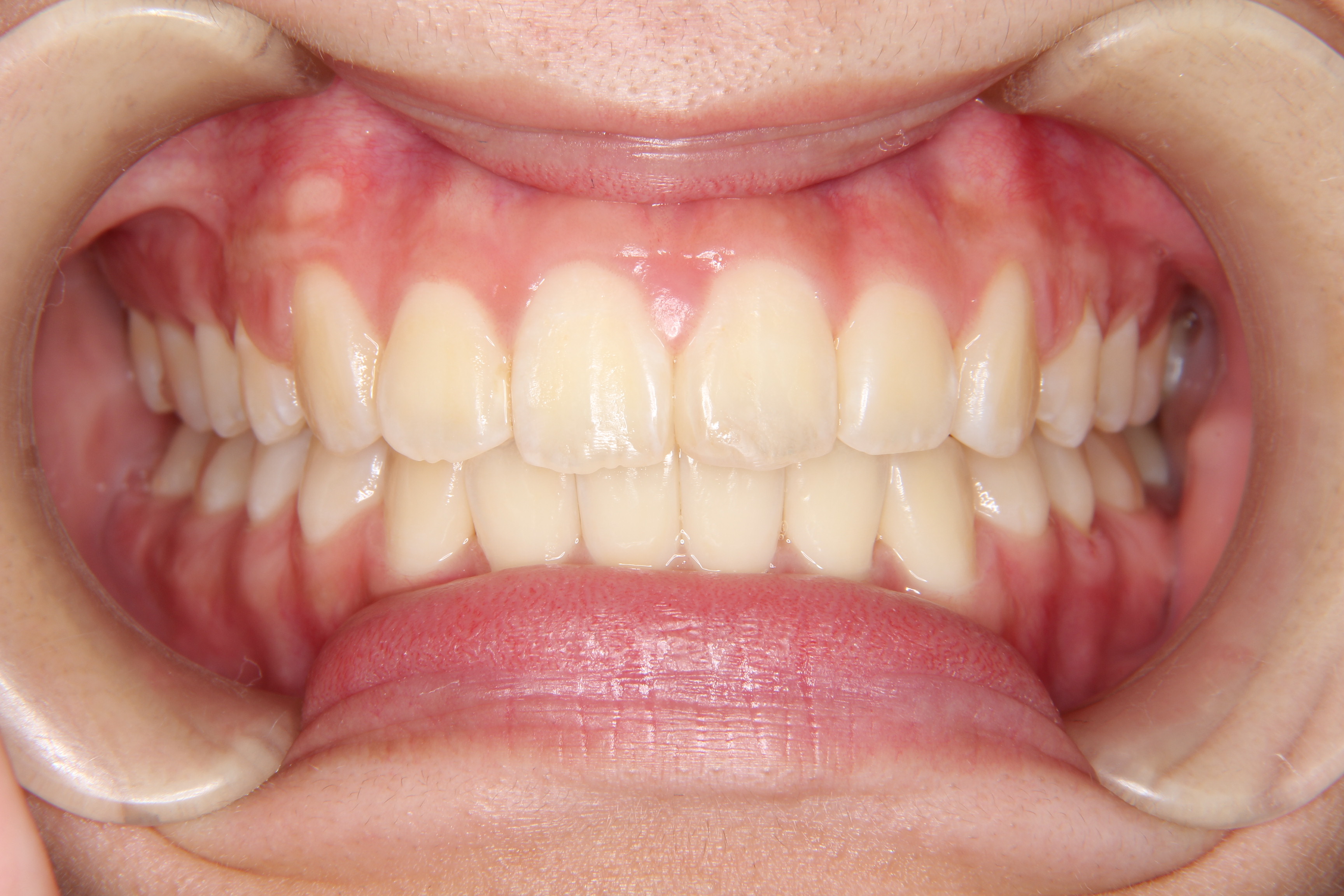 【高校生女子】上顎前歯のガタガタ歯の矯正歯科治療