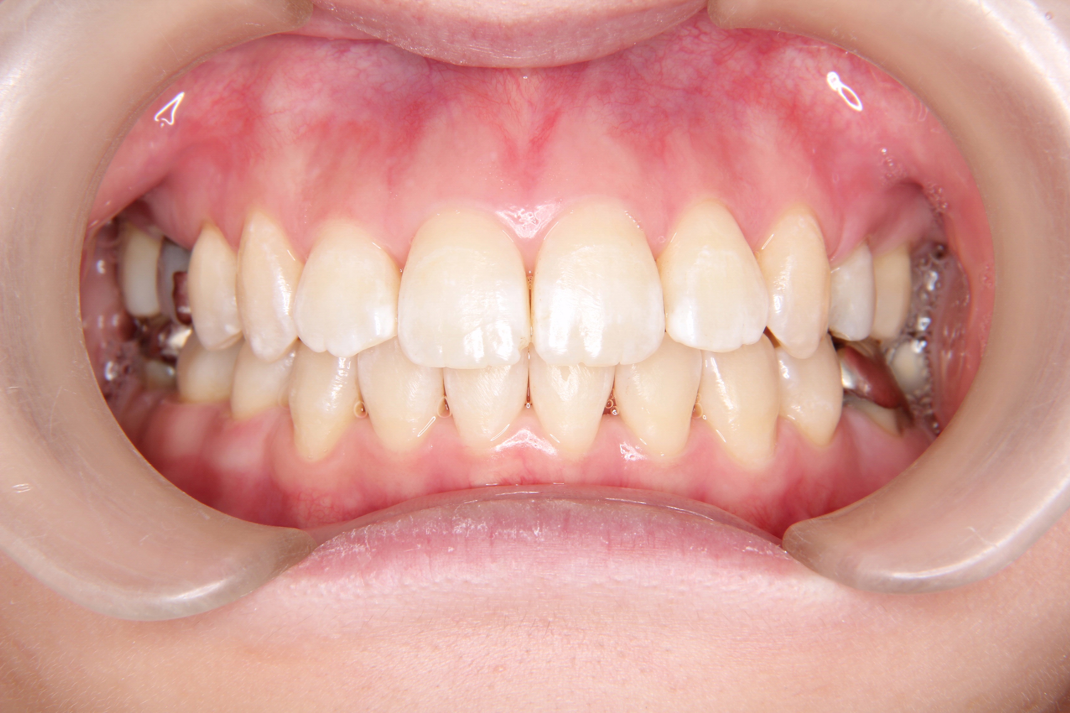 【20代　女子】開口・がたがた歯の矯正歯科治療