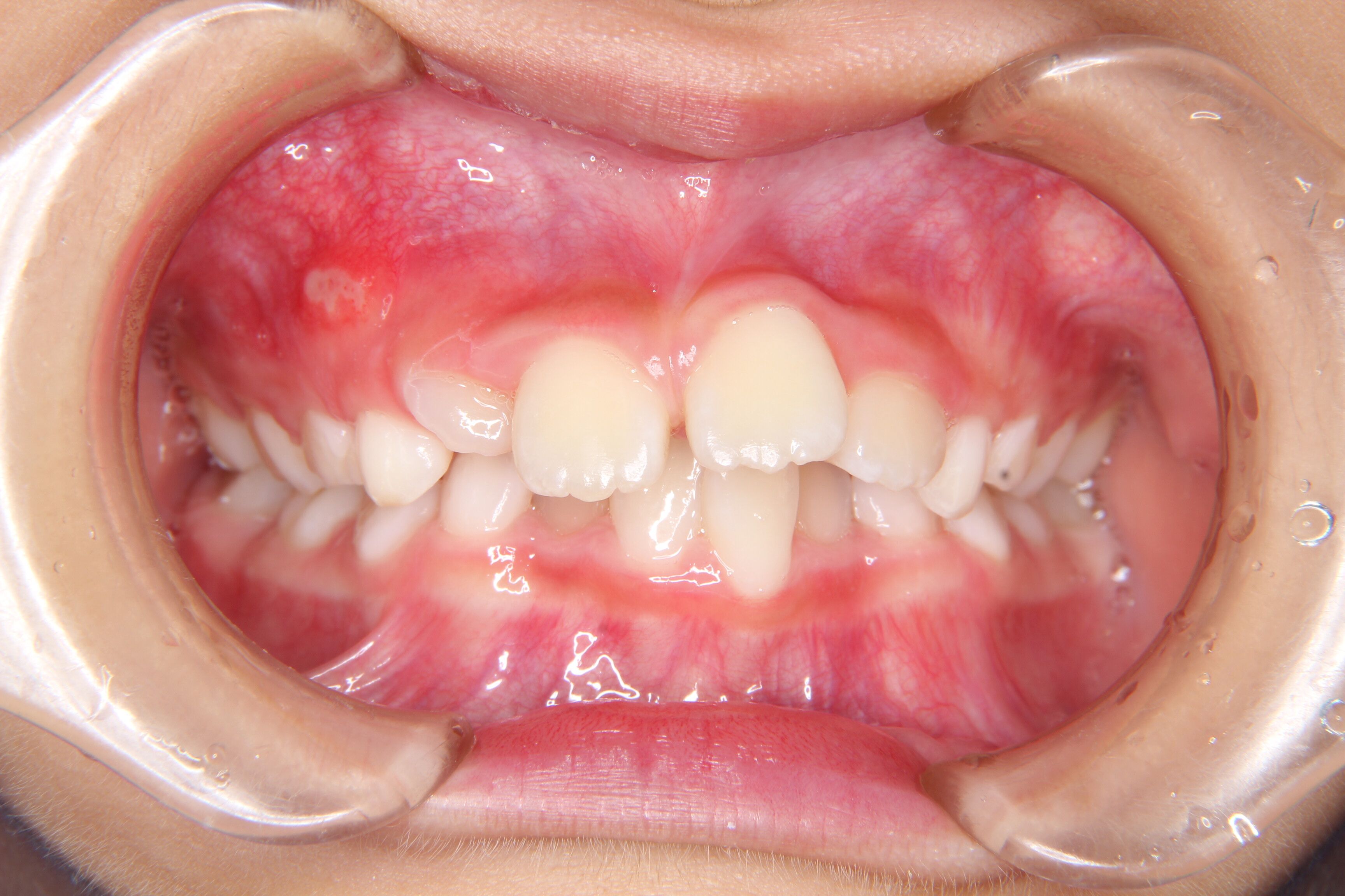 【小学校低学年　女子】出っ歯・がたがた歯の矯正歯科