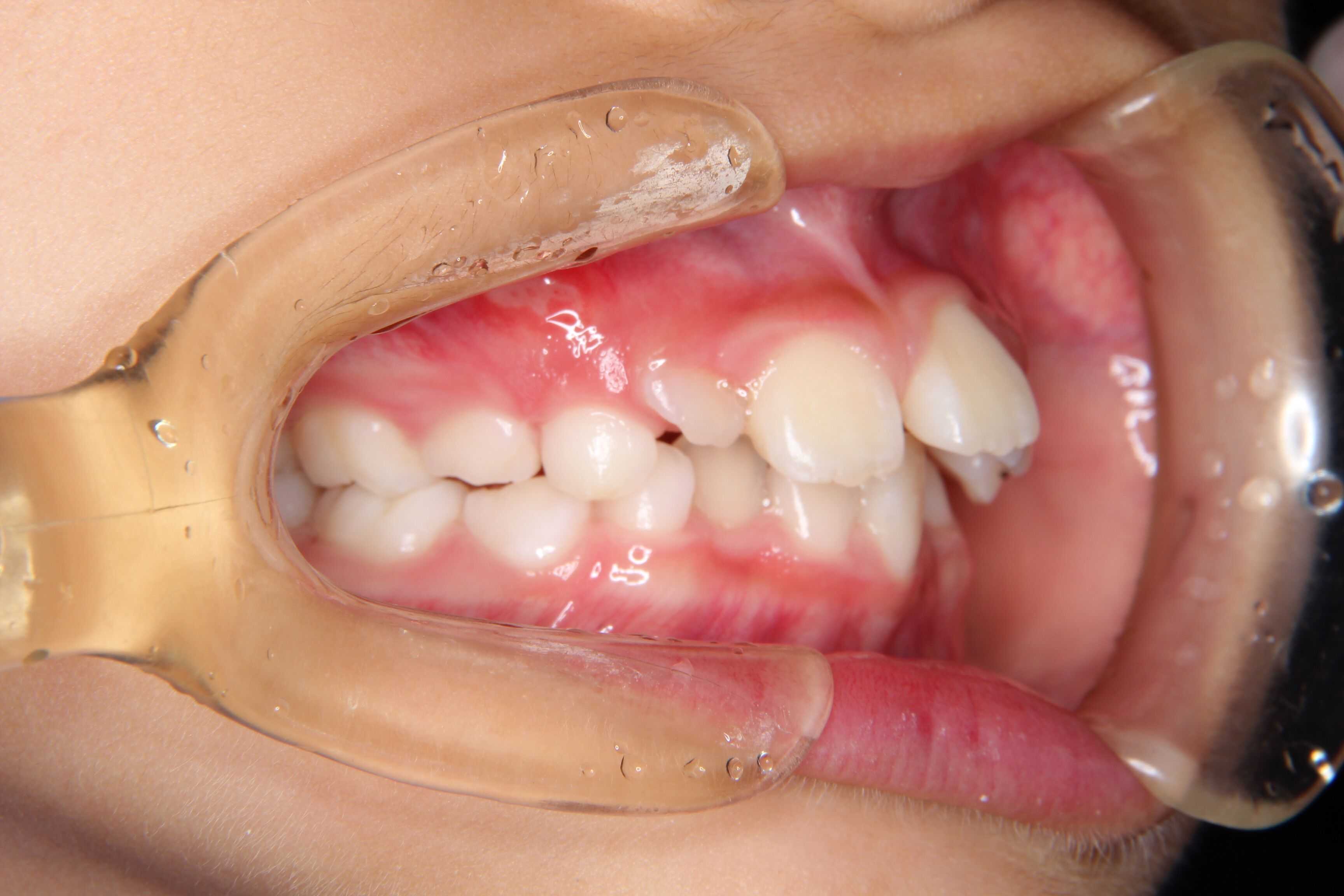【小学校低学年　女子】出っ歯・がたがた歯の矯正歯科