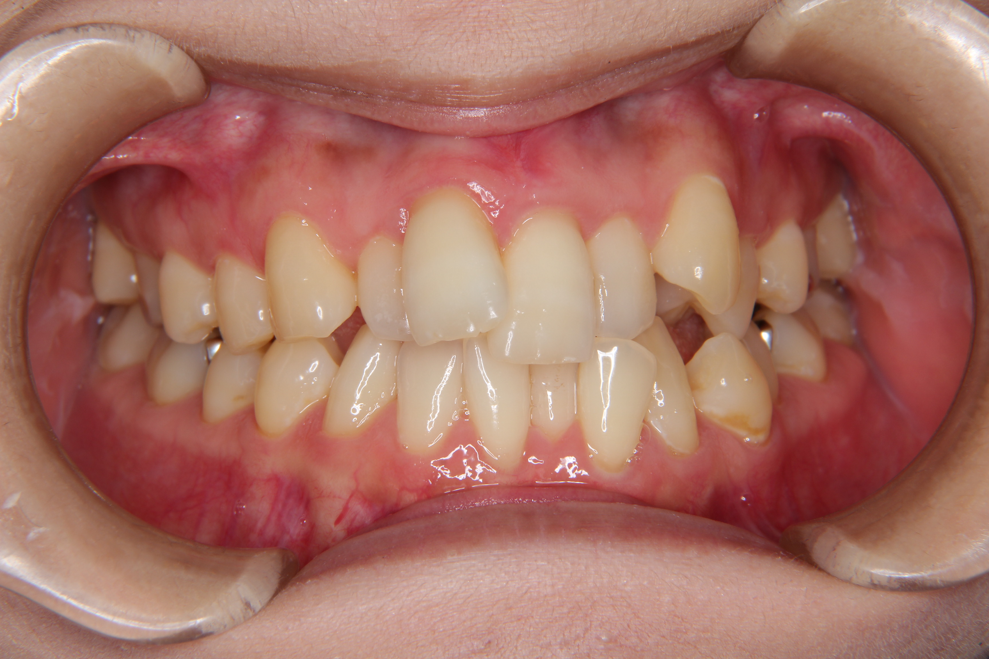【30代　女性】前歯のがたがた歯の矯正歯科治療