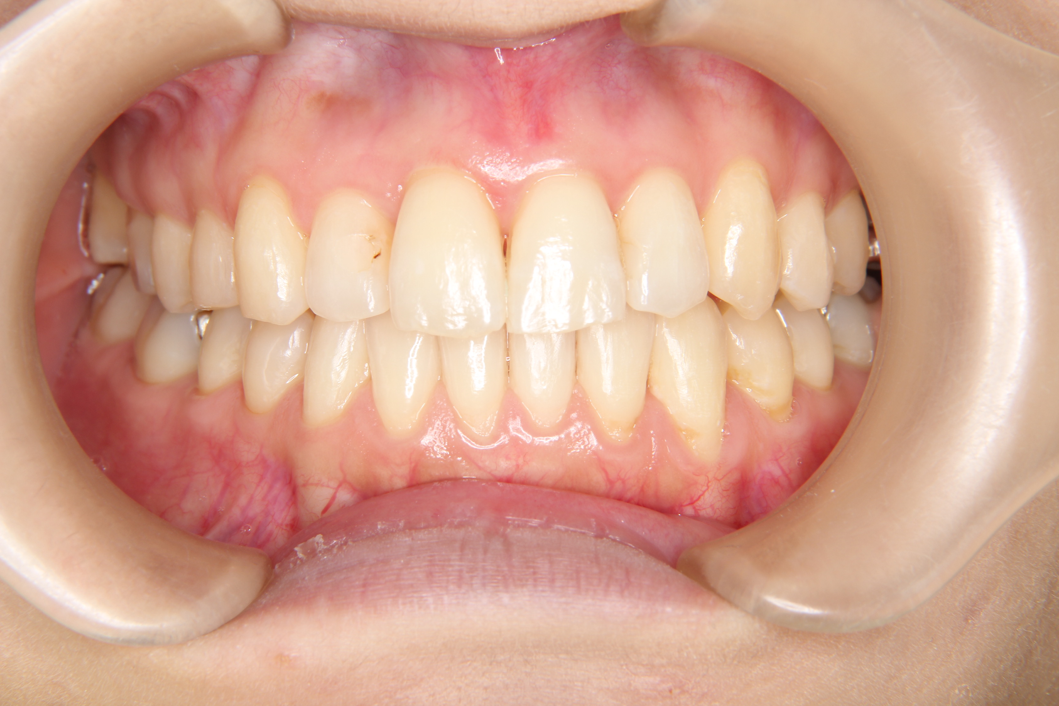 【30代　女性】前歯のがたがた歯の矯正歯科治療