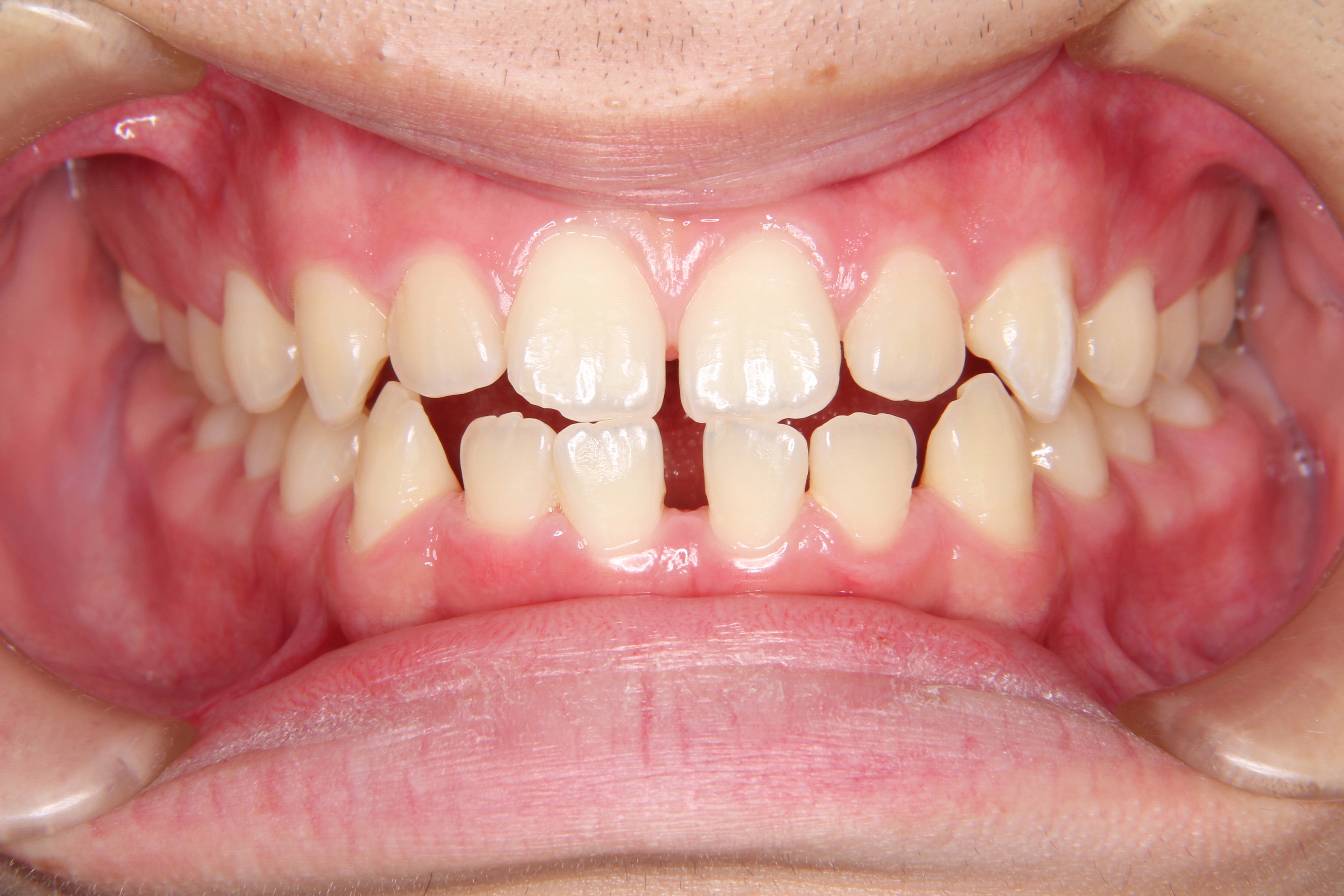 【10代　男性】前歯部反対咬合の矯正歯科治療