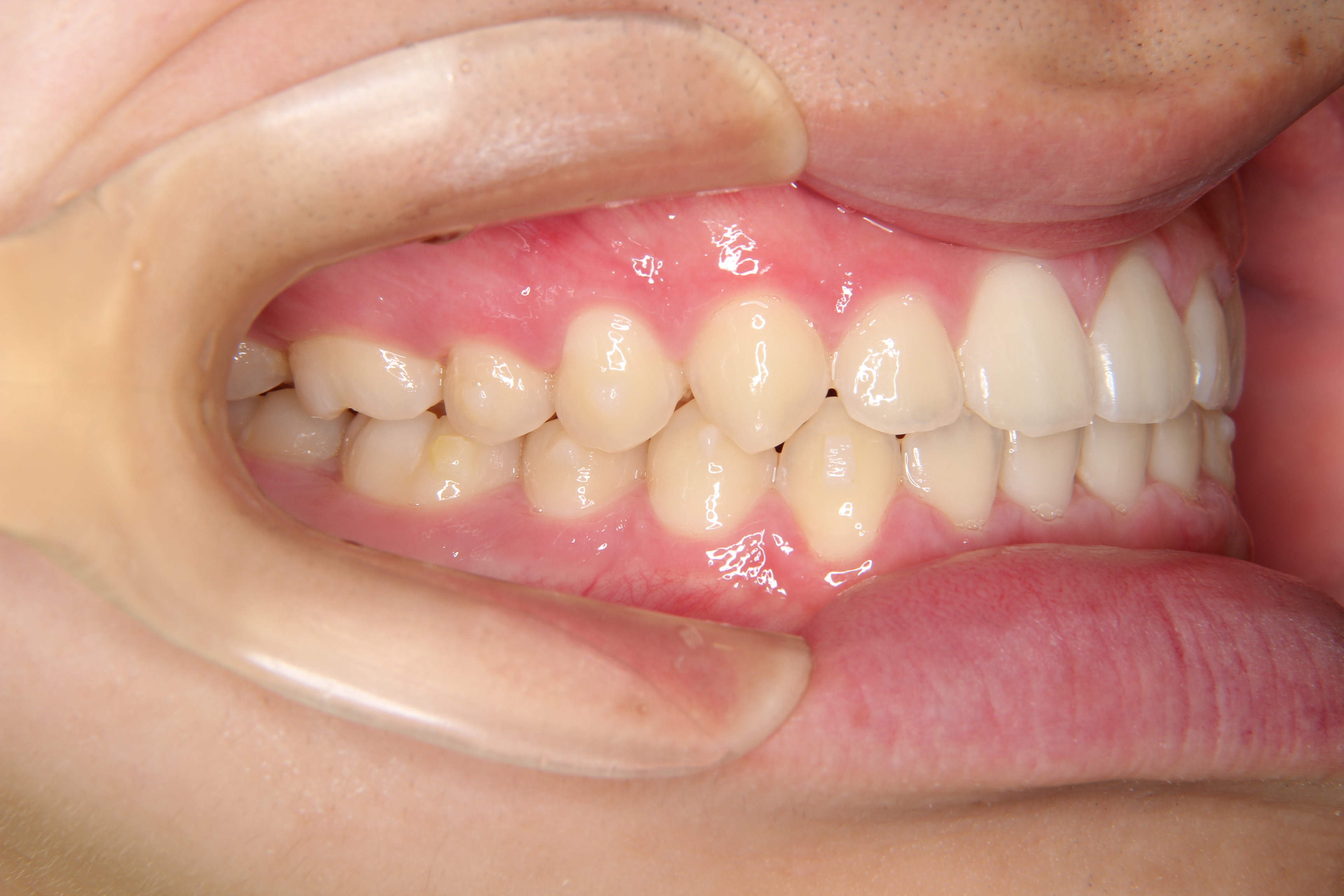 【10代　男性】前歯部反対咬合の矯正歯科治療