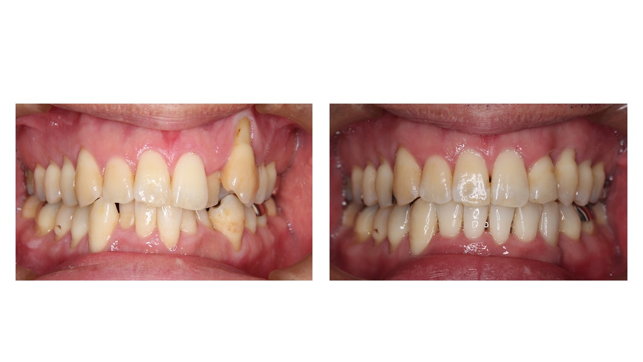 【４0代　男性】前歯のがたがた歯の矯正歯科治療
