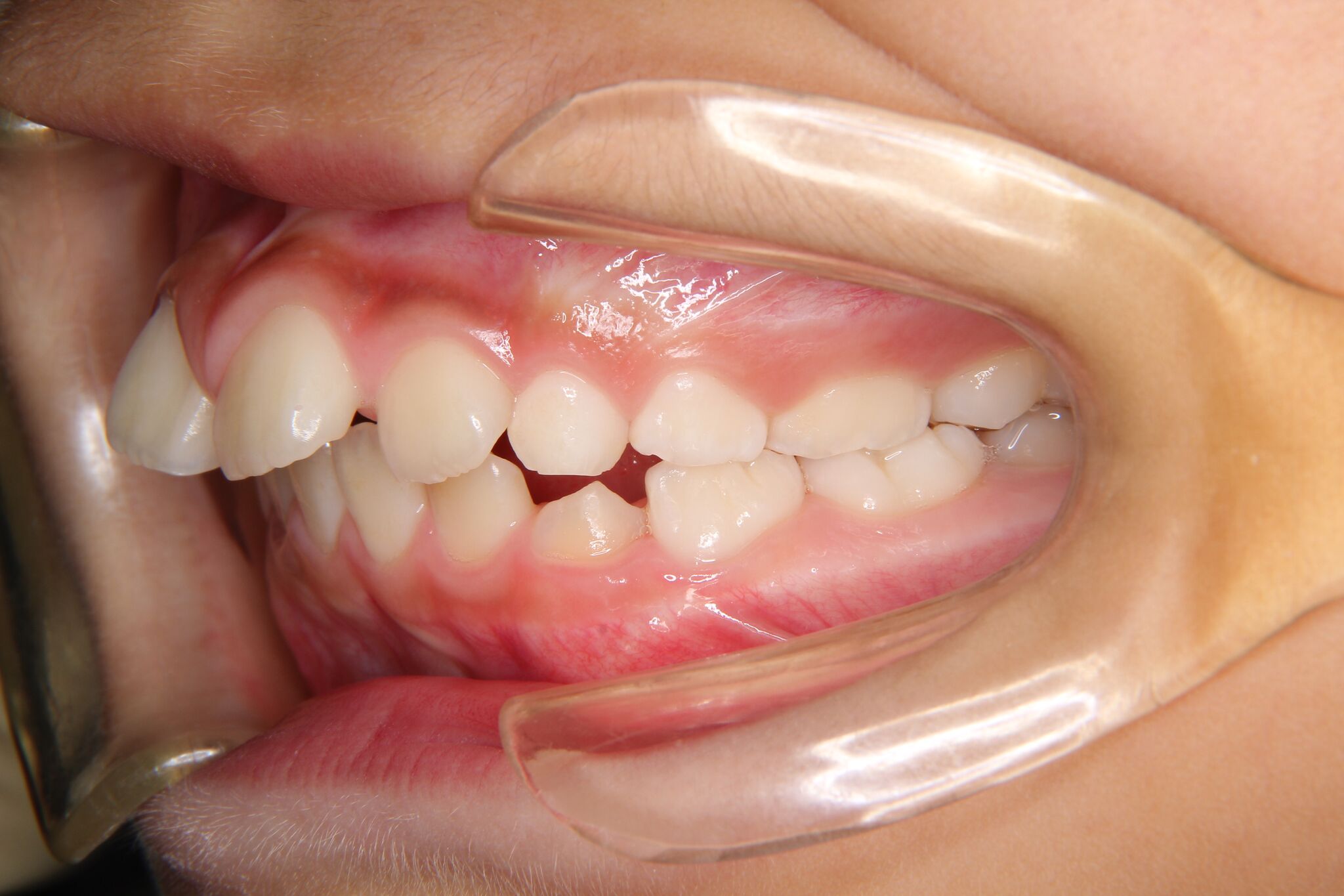 【小学４年生男子】出っ歯（上顎前突、下顎後退位、上顎前歯部叢生）