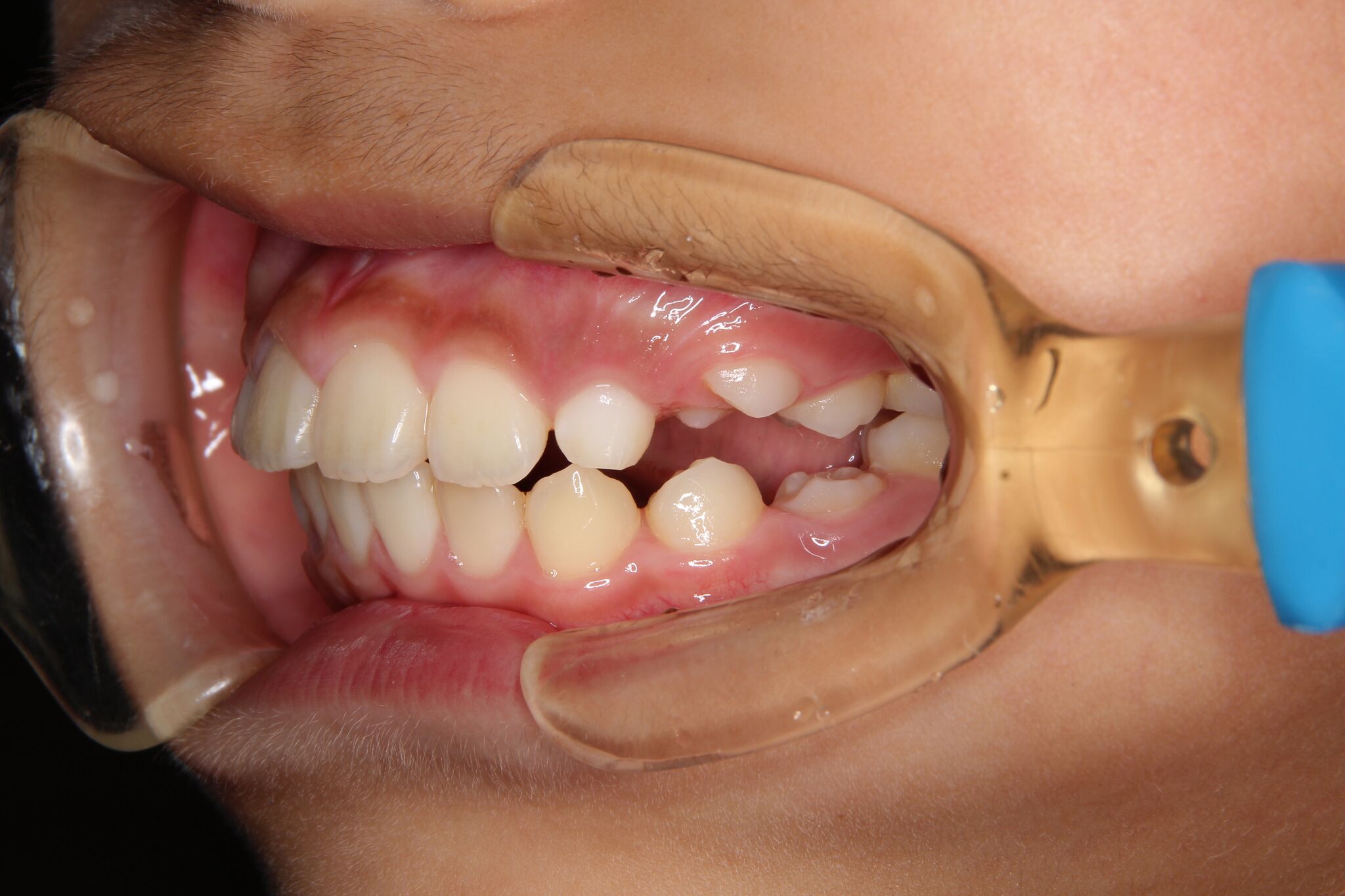 【小学４年生男子】出っ歯（上顎前突、下顎後退位、上顎前歯部叢生）