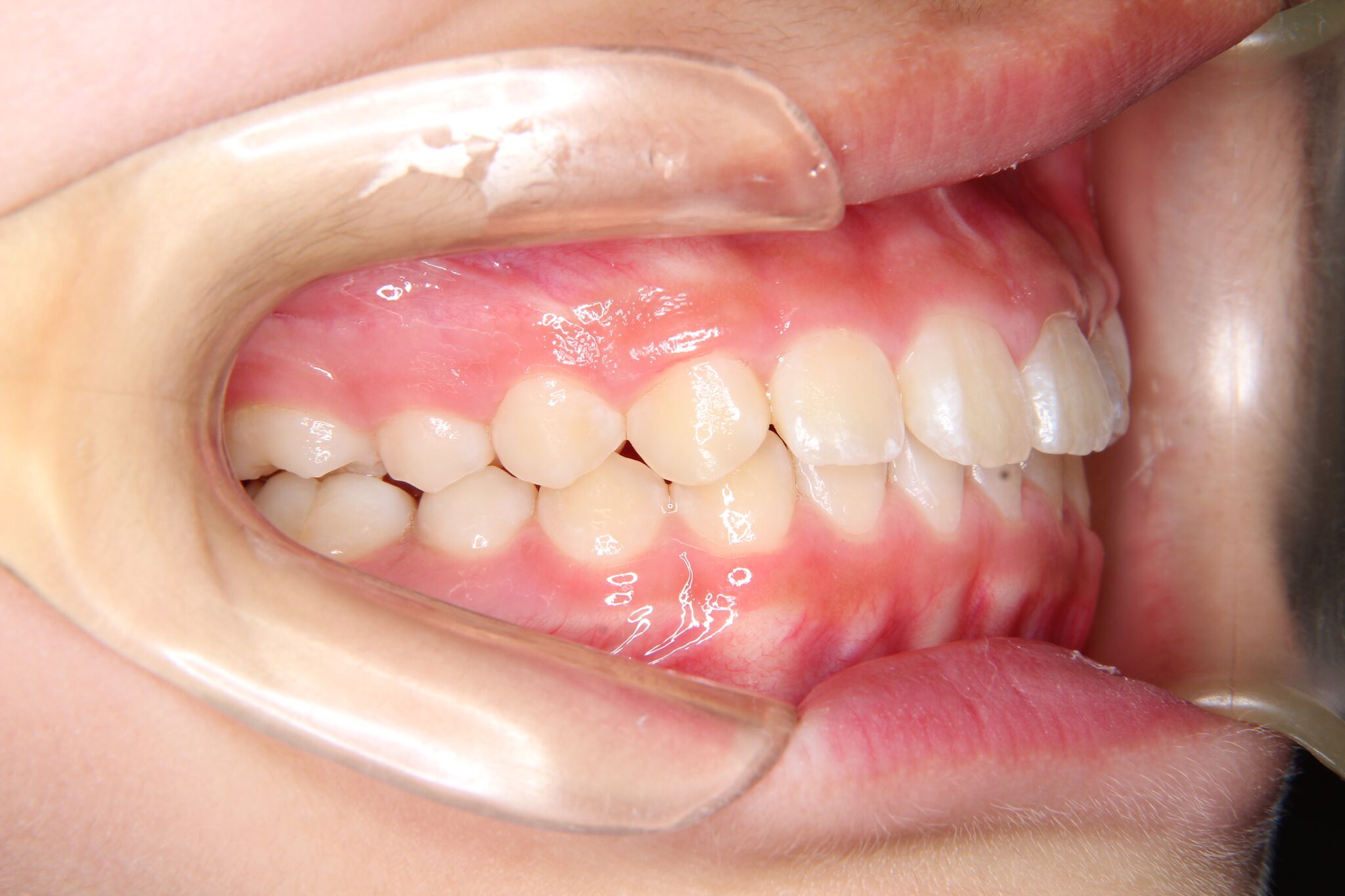 小学生女子 上顎前歯部のガタガタ歯 叢生 深い噛み合わせ 過蓋咬合 よしかわ矯正歯科 症例