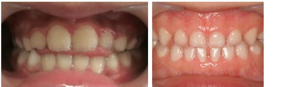 MFT（口腔筋機能療法）日舌癖とは？