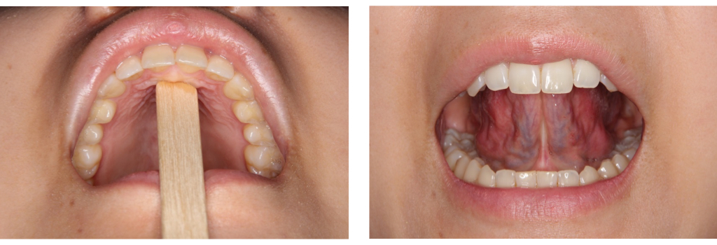 MFT（口腔筋機能療法）月レッスン方法