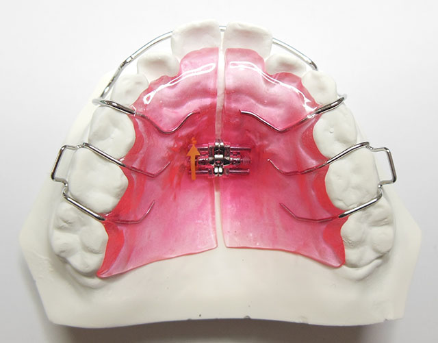 矯正装置２?(可撤式)